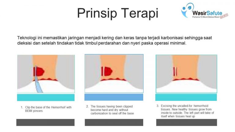 img-slide-presentation-update-artikel-wasir (14)