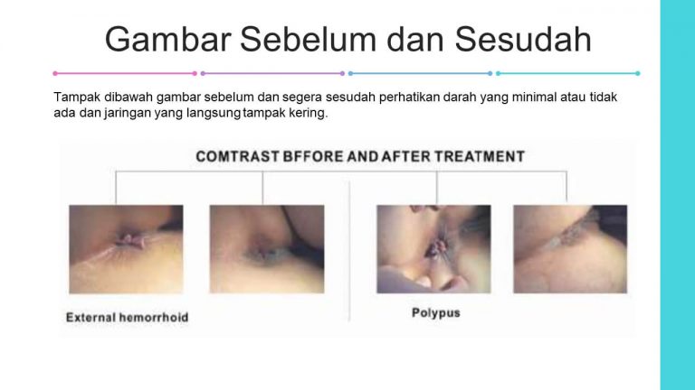 img-slide-presentation-update-artikel-wasir (16)