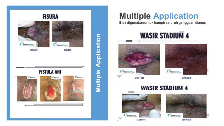 img-slide-presentation-update-artikel-wasir (17)