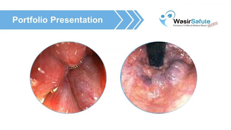 img-slide-presentation-update-artikel-wasir (4)