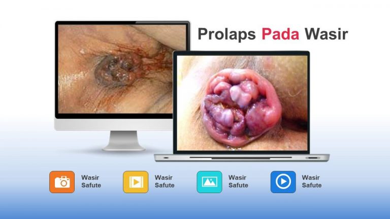 img-slide-presentation-update-artikel-wasir (5)